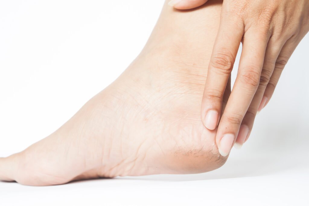L'immagine ritrae un piede diabetico