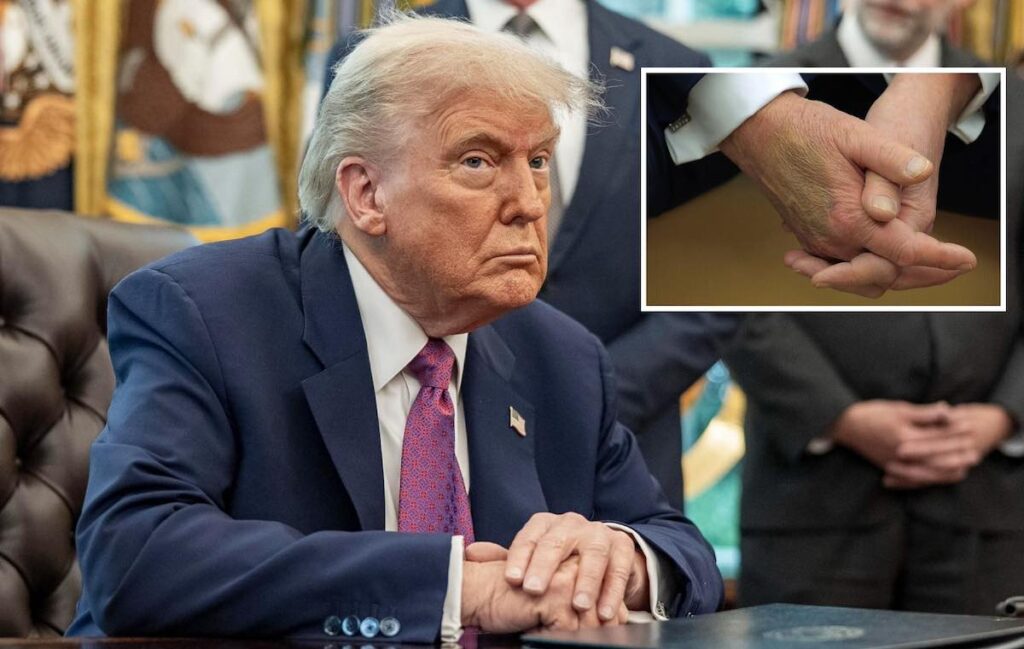 Donald Trump a Davos 2026 con vistosi lividi sulla mano sinistra